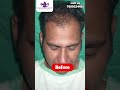 BEST RESULT FOR HAIR TRANSPLANT 