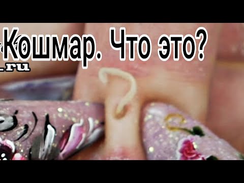 Такое бывает? НЕОЖИДАННАЯ НАХОДКА НА ПАЛЬЦЕ. Сложное лечение ногтей