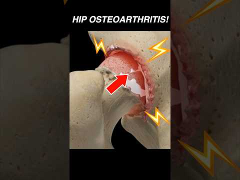 Doctor Explains: Hip