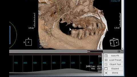 3D Segmentation - Method B.