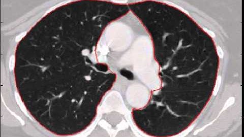 Detection of Pulmonary Nodules in Computer Tomography (FlyerScan)