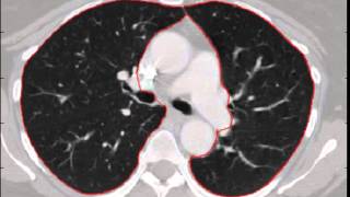 Detection of Pulmonary Nodules in Computer Tomography (FlyerScan)