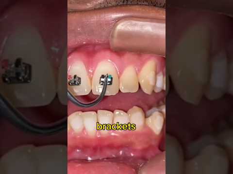 Video: ¿Duele apretar los brackets?