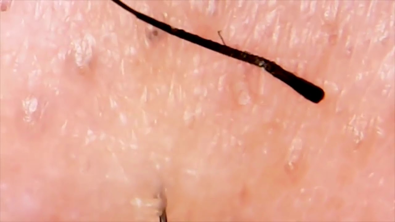 УДАЛЕНИЕ ВРОСШИХ ВОЛОС-ЧЕРВЕЙ ПИНЦЕТОМ!!! - YouTube