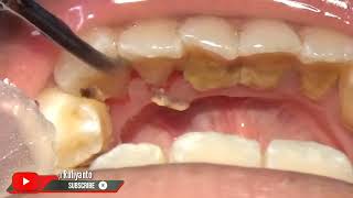 25 yo. Female&#39;s Teeth | Scaling | Dentist | Dokter Gigi Ruliyanto
