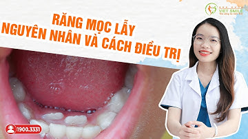 Răng mọc lẫy - nguyên nhân và cách điều trị - Bác sĩ giải đáp