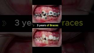 Braces case in 3 years. #braces #orthodontist #dentist