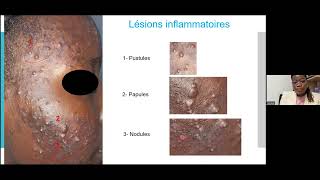 Acne Common Mistakes And Treatment