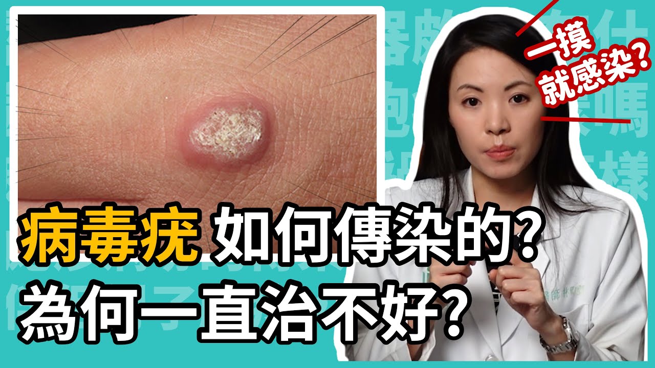 病毒疣是甚麼,為甚麼一直治療不好?病毒疣、菜花、雞眼,皮膚科林昀萱醫師,一招教你如何分辨。 - YouTube