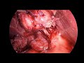 COLECISTECTOMIA LAPAROSCÓPICA - COLECISTITE AGUDA LITIÁSICA