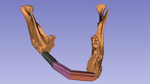 Mandible reconstruction on Slicer