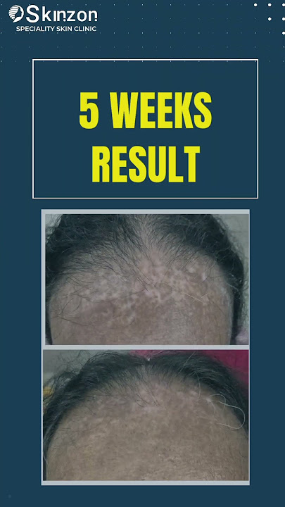 Excimer Laser for Vitiligo  #dermatologist #skincare #eximer #eximerlaser #vitíligo #whitepatches
