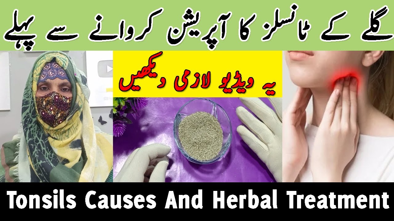 Tonsillitis and Peritonsillar Abscess Treatment & Management Throat Treatment YouTube