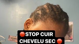 COMMENT LUTTER CONTRE LE CUIR CHEVELU SEC - ACTIFS ASTUCES