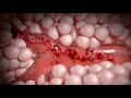 Understanding Sickle Cell Anemia