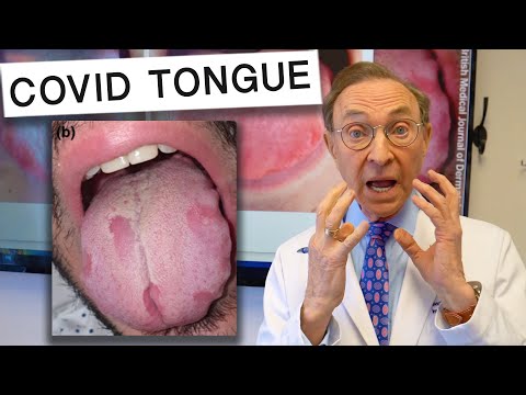 Video: Plaque on the tongue with coronavirus