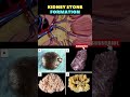 Kidney Stone formation Animation | Kidney stone removal | Kidney disease
