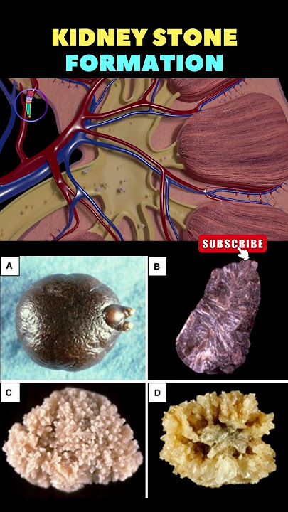 Kidney Stone formation Animation | Kidney stone removal | Kidney disease