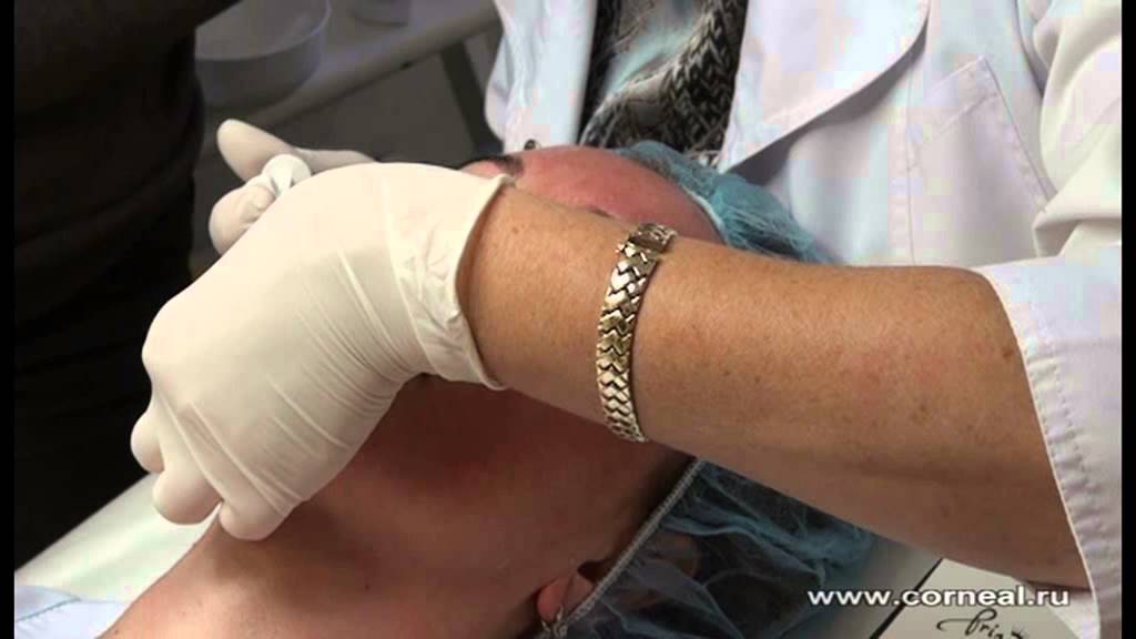 Папулы должны быть маленькими и аккуратными