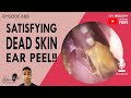 688 - Satisfying Dead Skin Ear Peel!