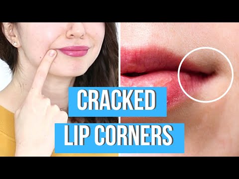 HOW TO CURE CRACKED LIP CORNERS | Healing Angular Cheilitis