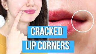 HOW TO CURE CRACKED LIP CORNERS | Healing Angular Cheilitis