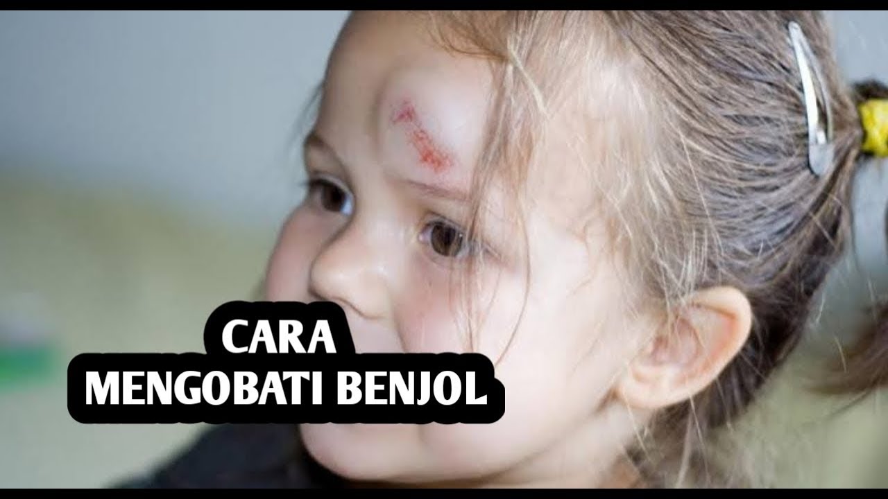CARA MENGOBATI BENJOL PADA ANAK ANDA