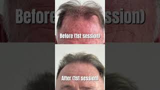 Hair Transplant Journey: From Hairline to Crown | NuHart Cebu FUE Results