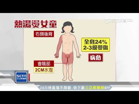 愛女全身24%燒燙傷　父PO網控園方不理｜三立新聞台