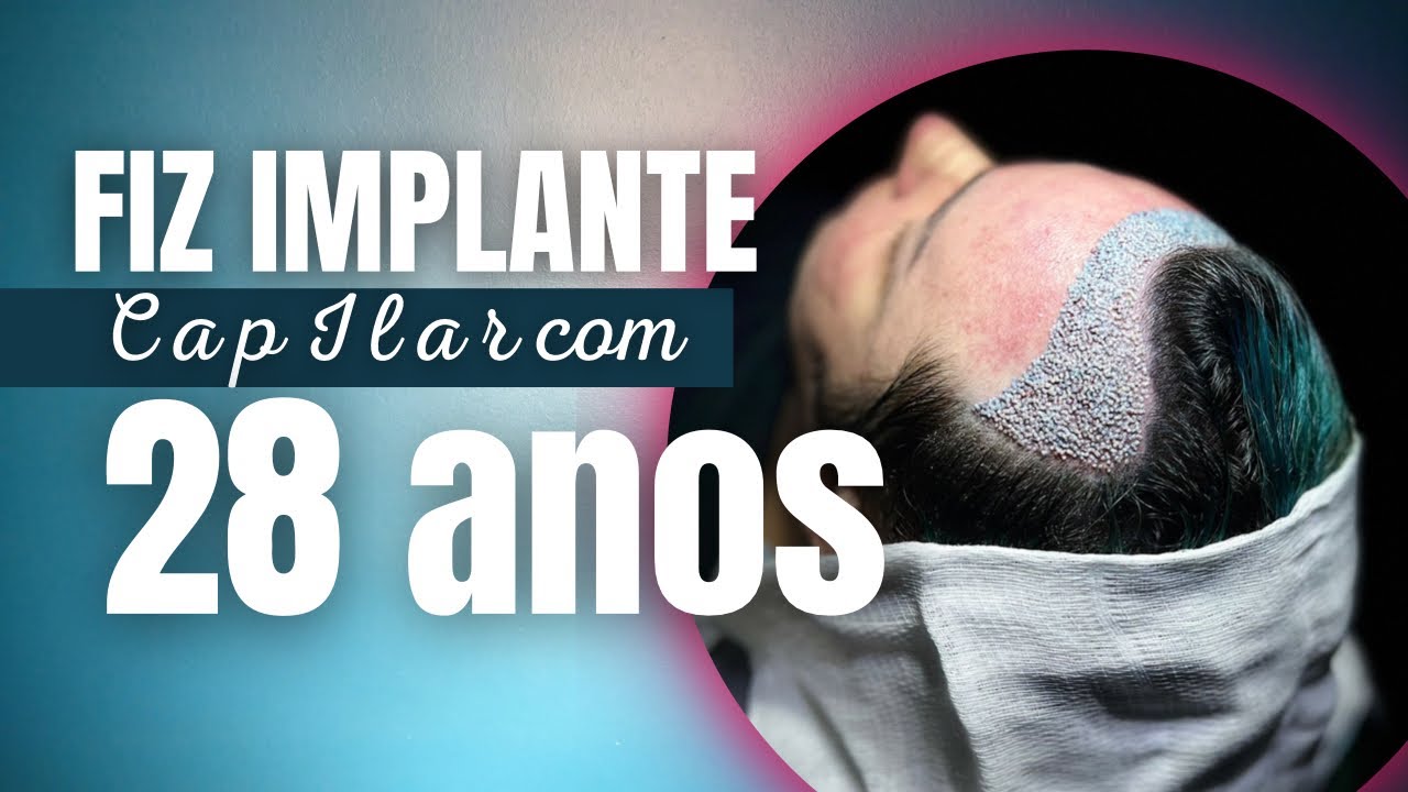 FIZ UM IMPLANTE CAPILAR COM O MELHOR DO BRASIL - YouTube