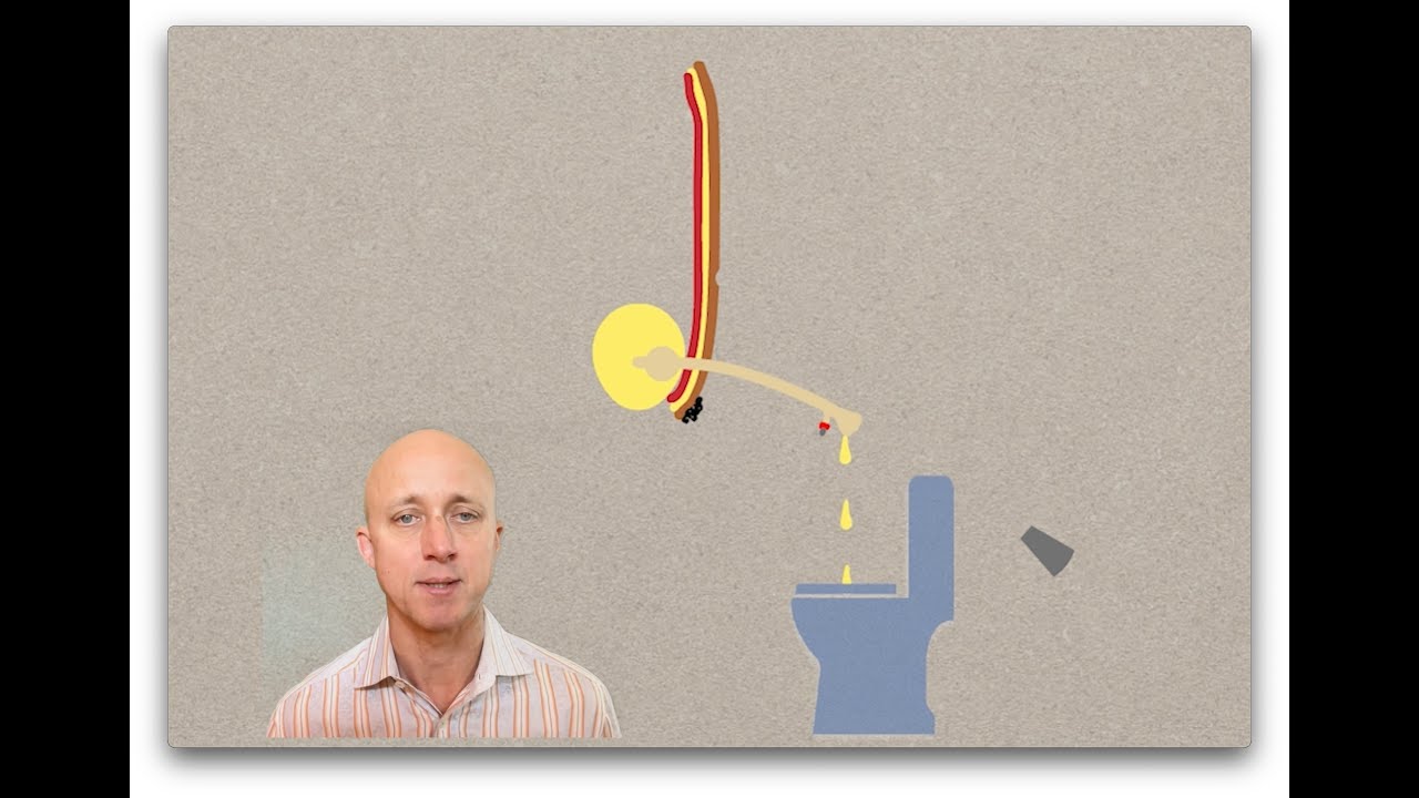 Suprapubic Tube vs. Mitrofanoff