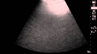 SC Emphysema thorax