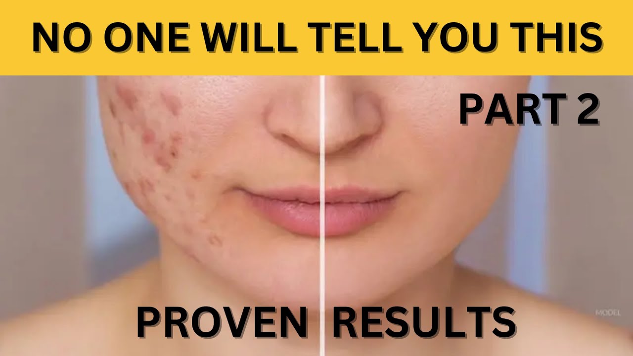 5 Home Remedies for Acne Scars Removal That Really Work PART 2 YouTube