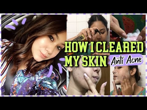 How I Cleared My Skin | 3 Steps For Acne Prone Skin | Teenagers/Adults ...