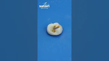 Лечение и пломбирование каналов зуба