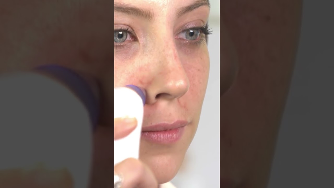 Derma Suction