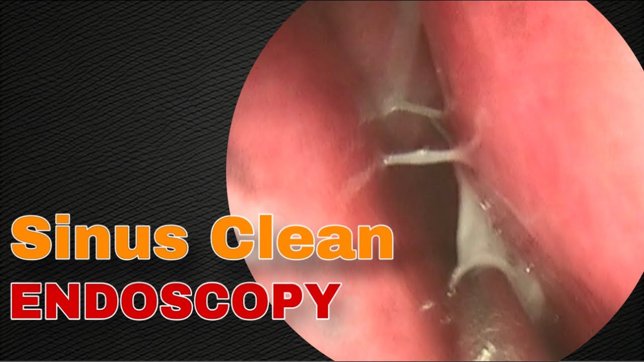 Endoscopy Sinus Clean Doctor Anh YouTube