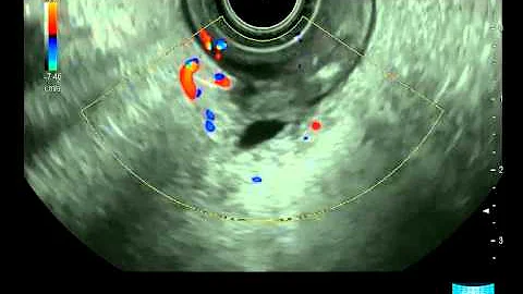 Endoscopic Ultrasound Examination of the Papilla and the Biliary System