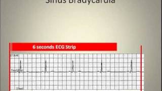 ECG Interpretation Video Lecture Module 3-A of 6