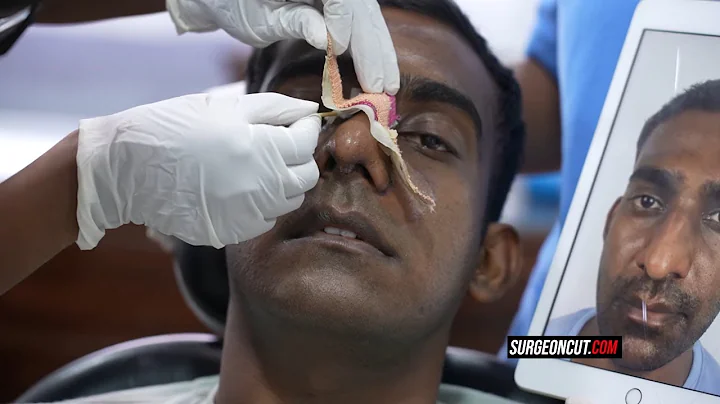 Transform Your Nose: Rhinoplasty for Enhanced Appearance and Breathing