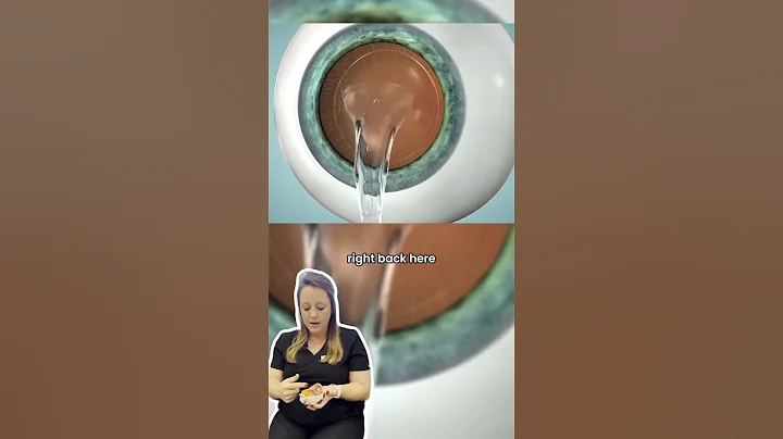 EVO ICL - Implantable Contact Lens