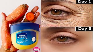 كيفية إزالة التجاعيد تحت العينين ، أكياس تحت العين ، انتفاخ العينين والهالات السوداء في 5 أيام بالجز