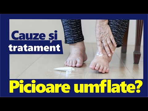 Video: Picioarele Umflate Cu Diabet Zaharat: Ce Trebuie Făcut, Cum Să Tratăm, Cauze