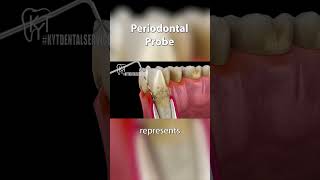 What is a Periodontal Probe & How Dentists Keep Tartar at Bay - KYT Dental Services Fountain Valley