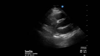 Right Ventricular Dilation Submassive Pe, Ultrasound, Parasternal Long