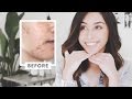 Comment jai limin ma routine acn  soins de la peau