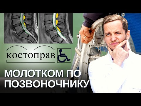 видео: Удары молотком по позвоночнику от боли в спине | Разбор МРТ пострадавших