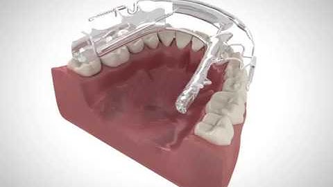 Inman Aligner Video