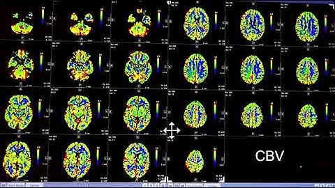Video 2 of 3:  How to Interpret a Brain CT Perfusion Scan for acute stroke
