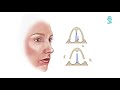 Rhinoplasty: Detailed animation about the operation